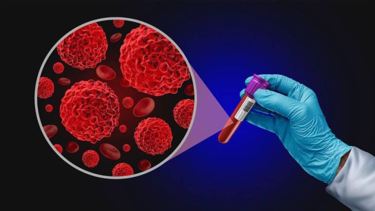 Liquid Biopsy: Detecting Cancer Through a Simple Blood Test