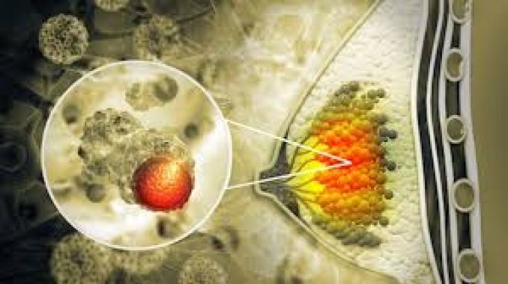 Microbiome and Cancer: How Gut Bacteria Influence Tumor Growth