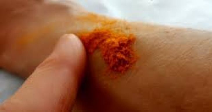 Use of Turmeric in Wound Healing