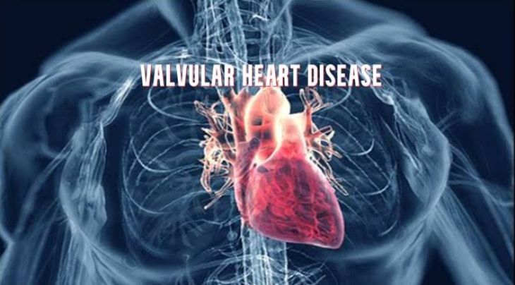Heart Valve Disease Explained: How Heart Valves Affect Overall Health