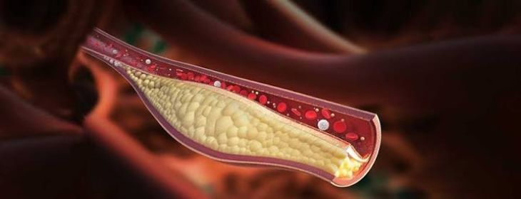 What Causes High Cholesterol and How Does It Affect the Heart?