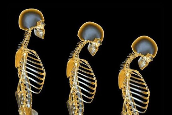 Understanding Osteoporosis and How It Affects Bone Health