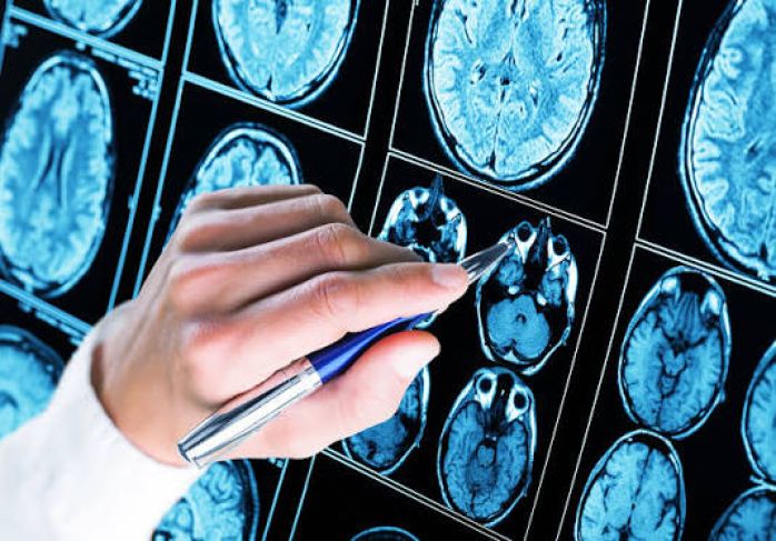 Understanding Epilepsy: Causes, Symptoms, and Treatment