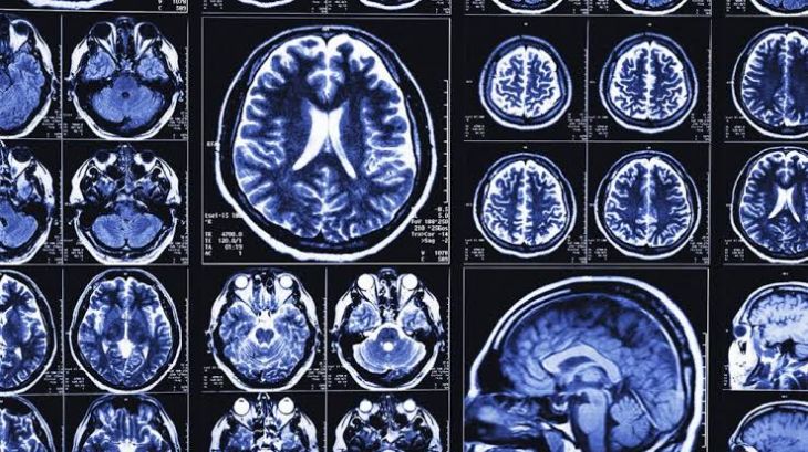 What Is Alzheimer’s Disease and How Does It Progress?