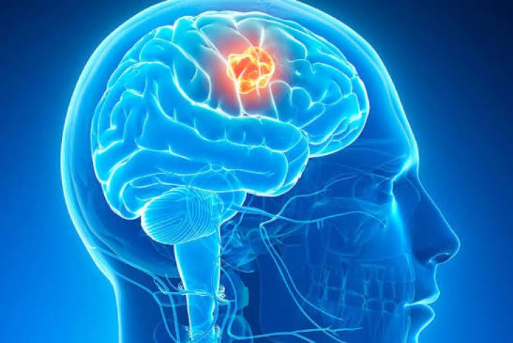 What Is a Brain Tumor and What Are Its Symptoms?