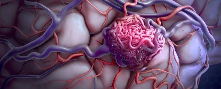 Understanding Cerebral Blood Vessel Bulges and Neurological Warning Signs