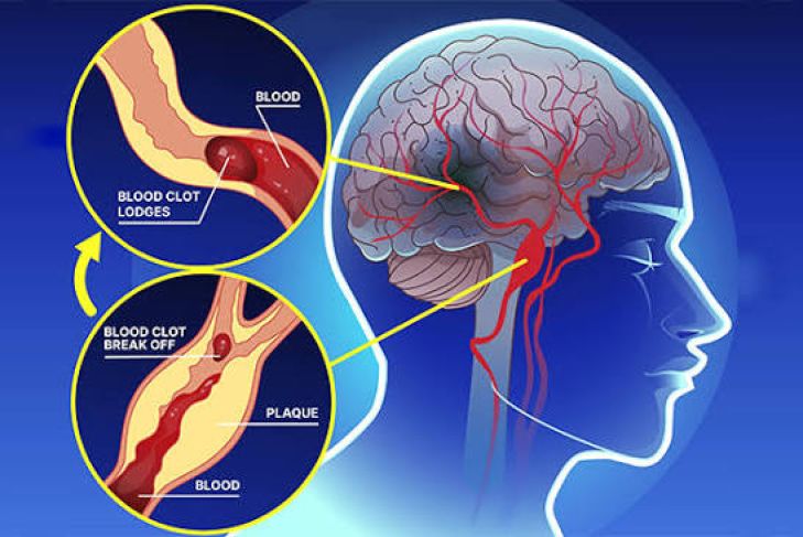 Understanding Brain Aneurysms and Their Warning Signs