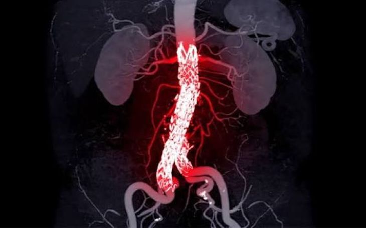 What Are Aortic Aneurysms and What Are Their Warning Signs?