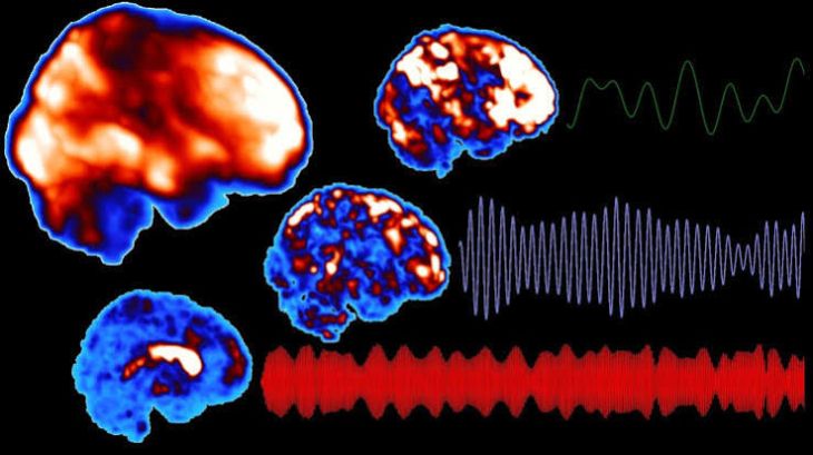 What Is Narcolepsy and How Does It Affect the Brain?