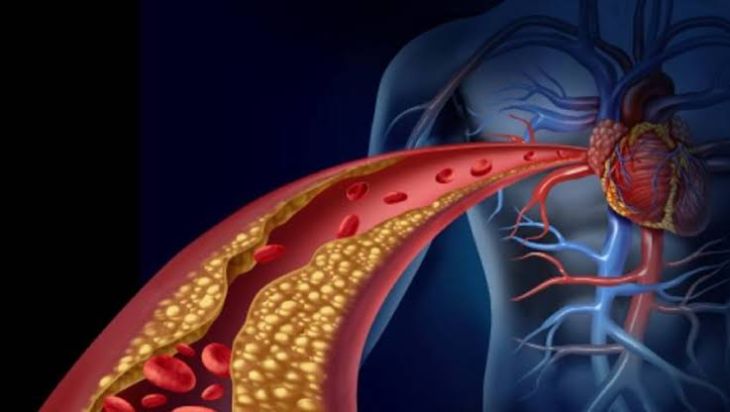 How High Cholesterol Can Lead to Heart Disease