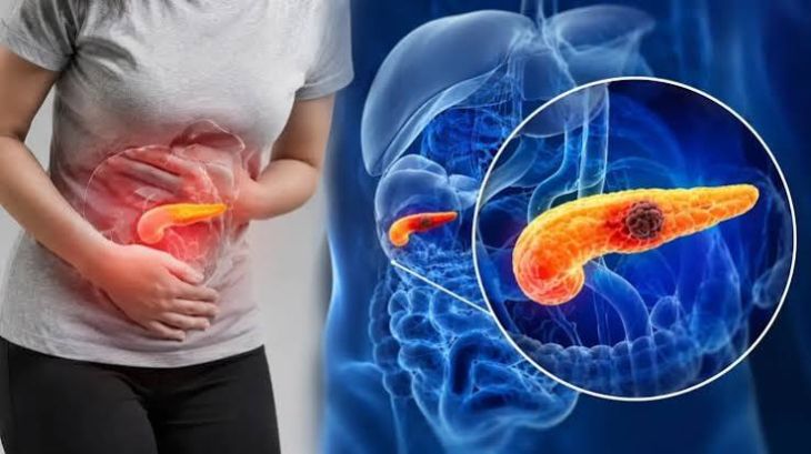 What Are the Risk Factors and Warning Signs for Pancreatic Cancer?