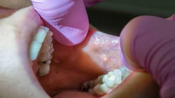Understanding Common Salivary Gland Disorders and Their Warning Signs