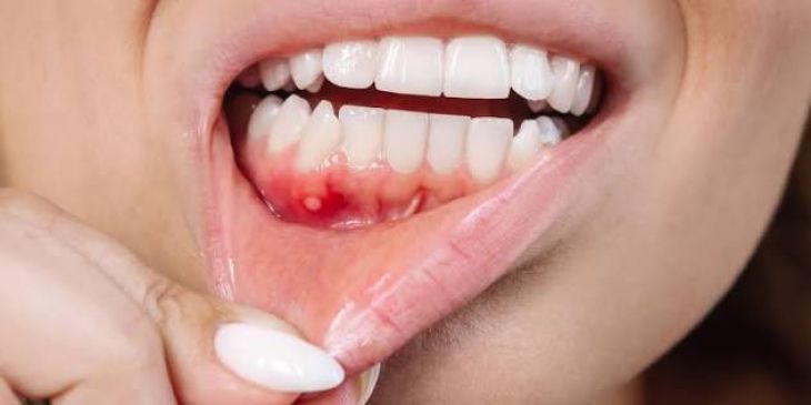 What Are the Early Warning Signs and Risk Factors of Oral Cancer?