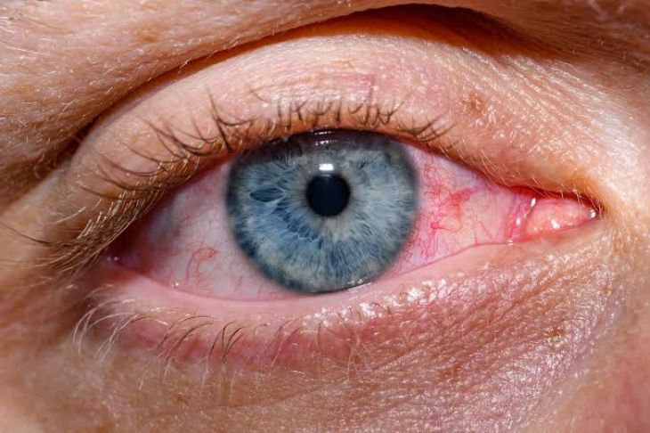 Understanding Common Disorders of the Lacrimal Glands and Tear Production