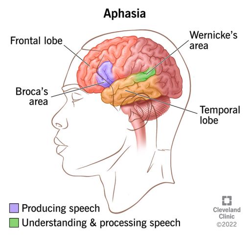 What Is Primary Progressive Aphasia and How Does It Affect Communication?