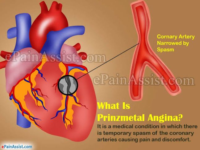 What Is Prinzmetal Angina and Why Can Coronary Arteries Suddenly Narrow?
