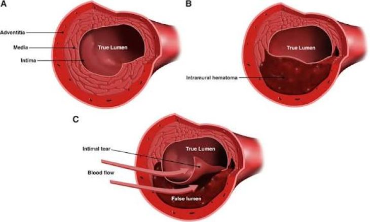 What Is Spontaneous Coronary Artery Dissection and How Can It Affect the Heart?