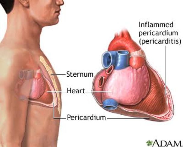 What Is Constrictive Pericarditis and How Does It Affect Heart Function?