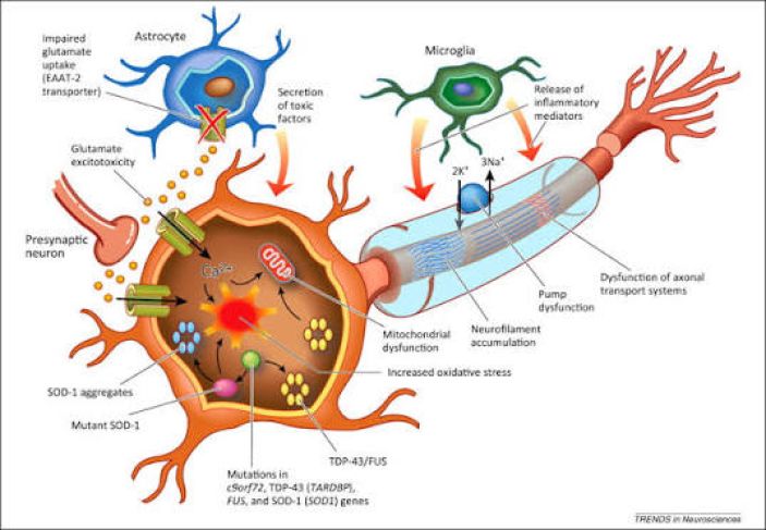 Understanding Primary Lateral Sclerosis and Its Effects on Movement