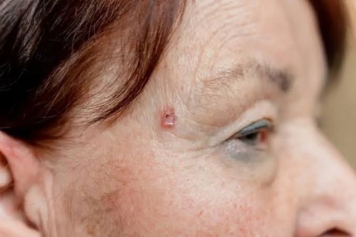 What Are the Symptoms, Risk Factors, and Diagnosis of Merkel Cell Carcinoma?