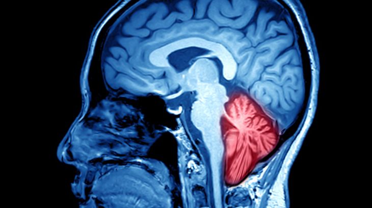 What Is Chiari Malformation and How Can It Affect the Brain and Spinal Cord?