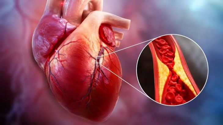 What Is a Coronary Artery Fistula and How Can It Affect Blood Flow?